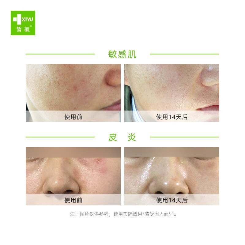 第一次贴面膜脸会刺痛