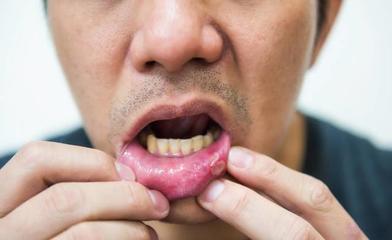 口腔溃疡能吃豆腐吗