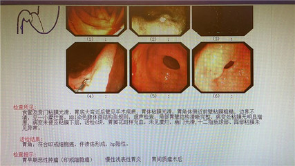 胃间质瘤是怎么回事