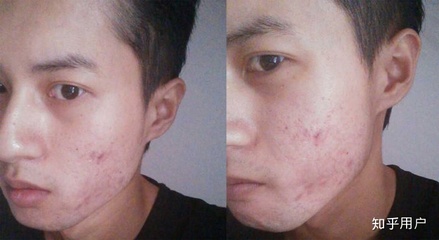 满脸都长痘痘怎么回事