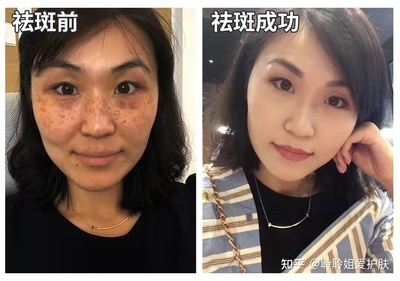 微针祛斑效果怎么样