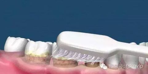 什么时候不能洗牙
