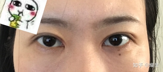 双眼皮疤痕多久才淡化
