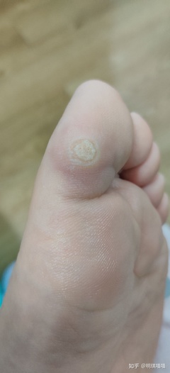 崴脚多少小时后能泡脚