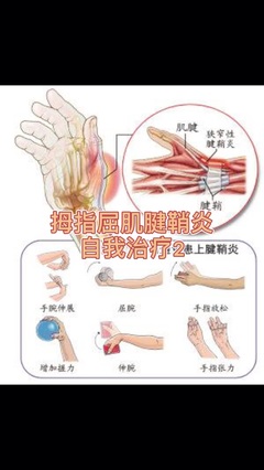手关节腱鞘炎怎么治疗