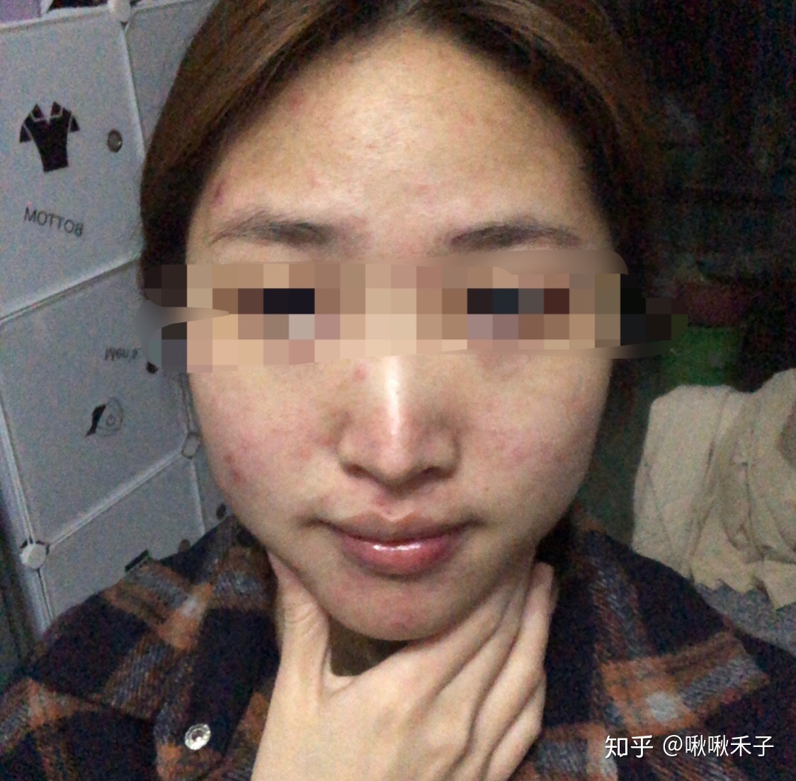 左边嘴巴长痘痘是什么原因