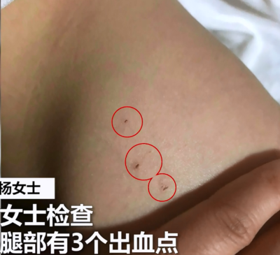 出血点是怎么回事