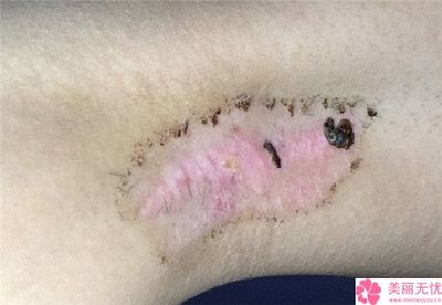 疤痕软化针的价格