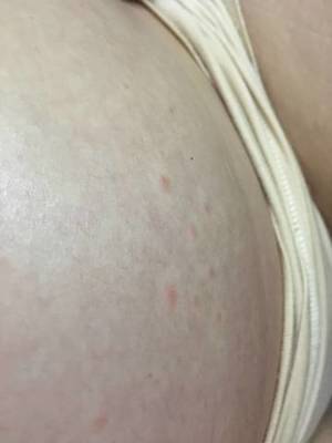 腿上毛孔发红