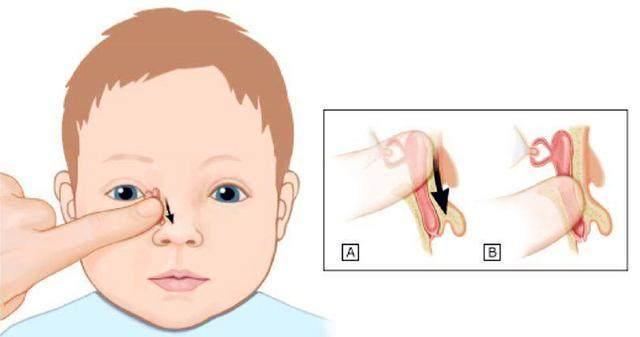 新生儿泪道堵塞的症状