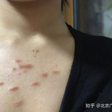 痘痘 疤痕疙瘩