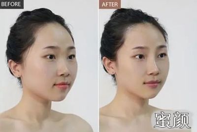玻尿酸填充多久恢复自然