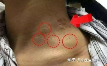 肠道淋巴结肿大是怎么回事