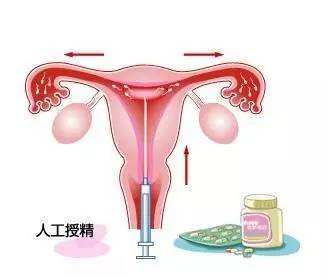 体外怀孕是什么意思