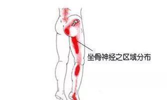 坐骨疼是怎么回事