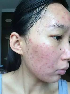 脸上的痘痘怎么样好的快啊
