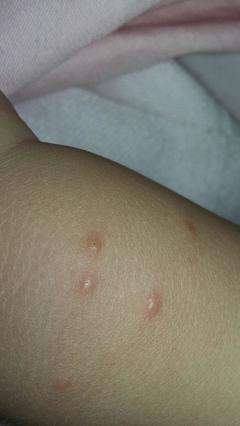 宝宝身上起红点