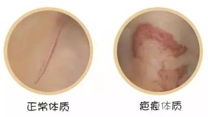 怎么确定是不是疤痕体质