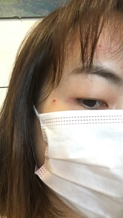 点痣几天结痂
