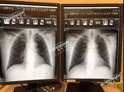 肺癌放疗20次多少钱