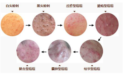 丘疹型痘痘严重么