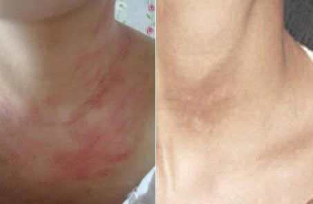 儿童皮疹怎么治疗