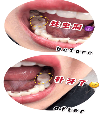 牙缝大怎么治疗