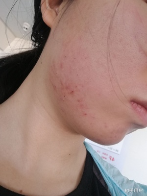 痘痘怎么能治好