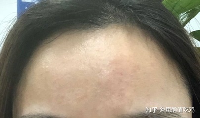 脑门额头长痘痘是什么原因