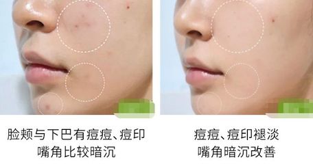 痘痘肌肤可以用精华液吗
