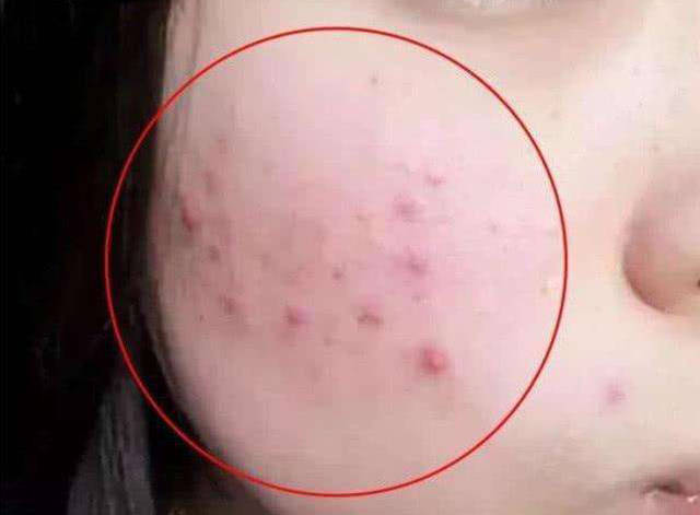 怎样区别是痘痘还是螨虫