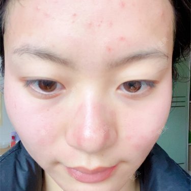 最疼的痘痘
