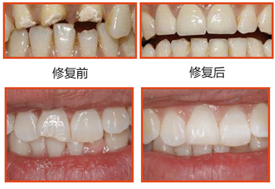 补牙整套多少钱