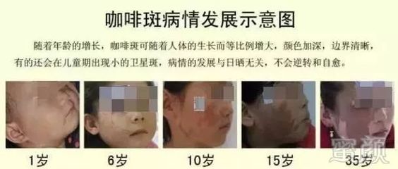 新生儿咖啡斑会消退吗