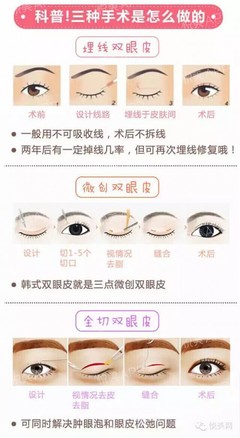 全切双眼皮怎么做