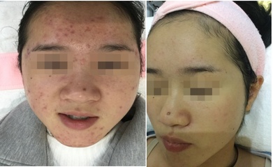 好多痘痘烦死了