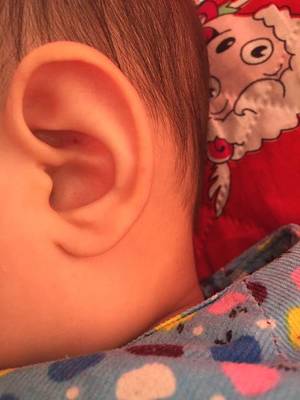 耳朵小痘痘是什么原因分析