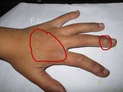 身上长肉刺是怎么回事