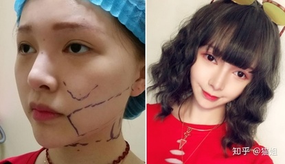 哪抽脂比较好