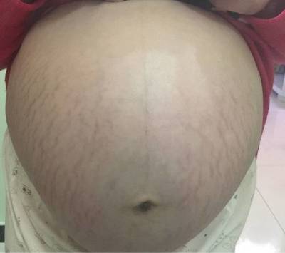一个月就有孕吐正常吗
