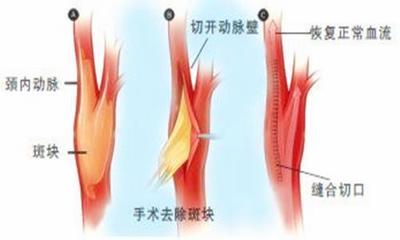内膜增厚怎么治疗好
