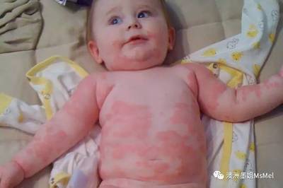 五个月宝宝出疹子怎么办