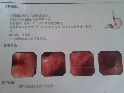 重度肠化怎么治疗