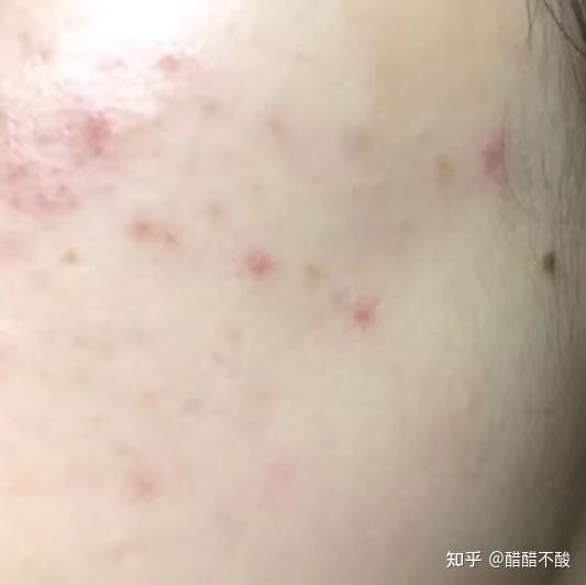 姨妈期起痘痘的原因