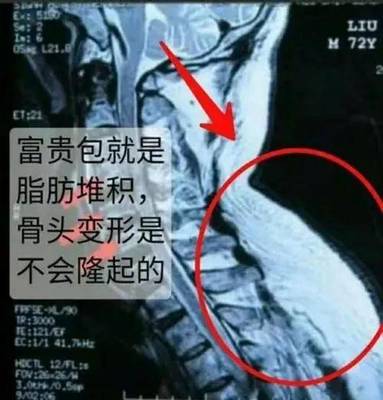 颈椎长个包是怎么回事