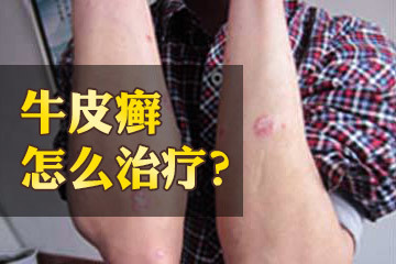 牛皮癣怎么治疗好