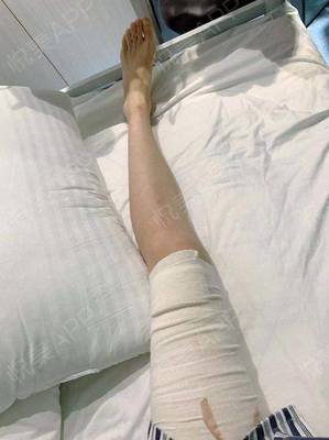 大腿感觉好酸痛是怎么回事