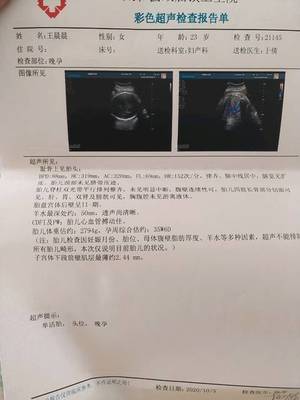 怎样检查胎儿是否缺氧