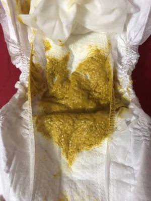 新生儿吃奶粉便秘拉不出来怎么办