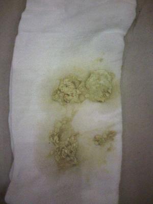 屎是白色的怎么回事